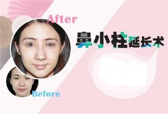 鼻小柱延长术