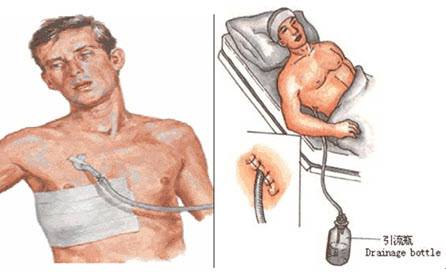 胸膜腔闭式引流术