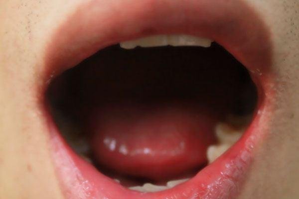 舌苔发白怎么办？